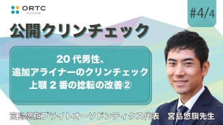 20代男性、追加アライナーのクリンチェック 上顎2番の捻転の改善2【インビザライン】