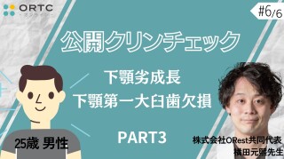 【インビザラインクリンチェック/矯正症例】25歳男性　下顎劣成長　下顎第一大臼歯欠損 PART3