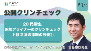 20代男性、追加アライナーのクリンチェック 上顎2番の捻転の改善1【インビザライン】