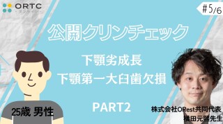 【インビザラインクリンチェック/矯正症例】25歳男性　下顎劣成長　下顎第一大臼歯欠損 PART2