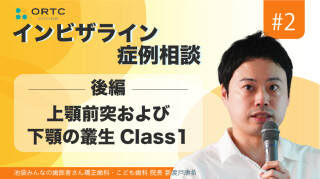 上顎前突および下顎の叢生Class1 後編