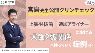 宮島先生公開クリンチェック 上顎44抜歯、追加アライナーにおける犬歯2級関係へ持っていく症例4