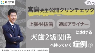 宮島先生公開クリンチェック 上顎44抜歯、追加アライナーにおける犬歯2級関係へ持っていく症例5