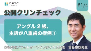 アングル2級、主訴が八重歯の症例【インビザライン】