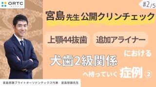 宮島先生公開クリンチェック 上顎44抜歯、追加アライナーにおける犬歯2級関係へ持っていく症例2