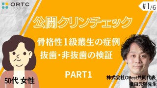 【インビザラインクリンチェック/矯正症例】50歳女性 骨格性1級叢生の症例 抜歯・非抜歯の検証 PART1