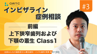 上下狭窄歯列および下顎の叢生 Class1 前編
