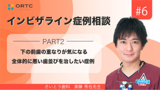 下の前歯の重なりが気になる、全体的に悪い歯並びを治したい症例　PART2