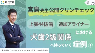 宮島先生公開クリンチェック 上顎44抜歯、追加アライナーにおける犬歯2級関係へ持っていく症例